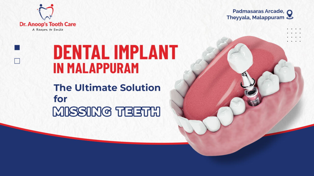 Dental Implant: The Ultimate Solution for Missing Teeth &#8211; An Introduction to Benefits and Process